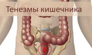 Почему возникают кишечные тенезмы и как их лечить?