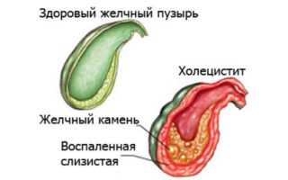 Почему болят ребра с правой стороны при нажатии и надавливании, кашле, вдохе и движении