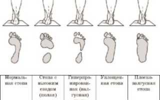 Можно ли заниматься бегом при плоскостопии и рекомендации для здоровья