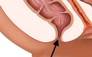 Недостаточность анального сфинктера: степени, причины и методы лечения патологии
