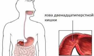 Тромбоз кишечника: почему возникает и как лечить патологию?