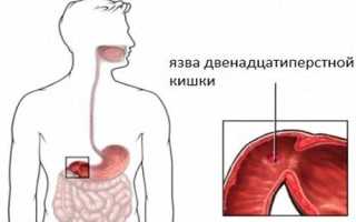 Ложные позывы к дефекации: почему появляются и как лечатся?