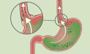 Заброс желчи в желудок: что делать, советы гастроэнтеролога, прием желчегонных препаратов