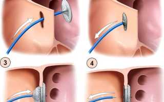 Лечение дефекта межпредсердной перегородки