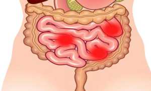 Дискинезия кишечника: виды, причины, симптомы и методы лечения