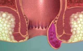 Тромбоз геморроидального узла: как проявляется и лечится патология
