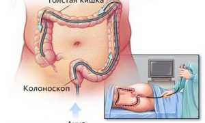 Подробно о колоноскопии кишечника: подготовка и ход процедуры