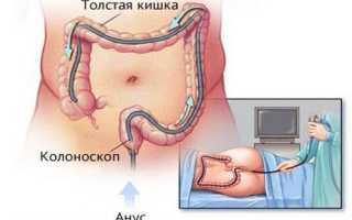 Подробно о колоноскопии кишечника: подготовка и ход процедуры