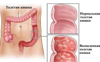 Колит кишечника: симптомы и лечение у взрослых