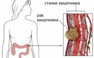 Подробно о раке кишечника: стадии, симптомы, лечение и прогноз