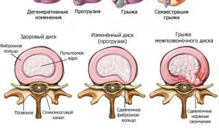 Лечение грыжи диска — билет в жизнь без дискомфорта