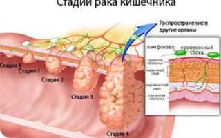 Как проверить кишечник на онкологию?