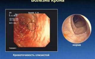 Подробно о болезни Крона: симптомы и методы лечения патологии