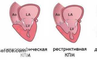 Вторичная кардиопатия симптомы