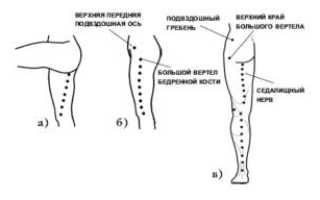 Можно ли делать массаж при защемлении седалищного нерва