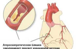 Парасистолия и экстрасистолия в чем отличия