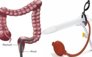Подготовка и проведении ректороманоскопии