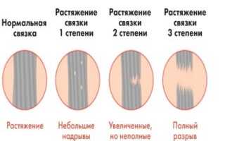 Связки бедра и таза: подвздошно- бедренная, седалищно-бедренная, круглая