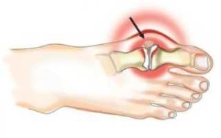 Лечение артроза плюснефалангового сустава 1 пальца стопы (большого пальца)