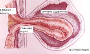 Грыжа передней брюшной стенки: виды и лечение (операция, восстановительный период)