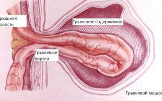 Грыжа передней брюшной стенки: виды и лечение (операция, восстановительный период)