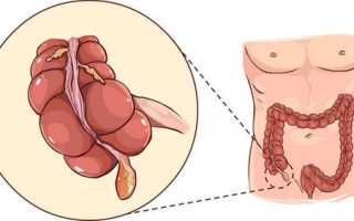 Аппендицит: основные признаки и лечение патологии + FAQ