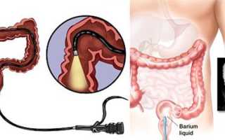 Ирригоскопия и колоноскопия: какое из исследований лучше?