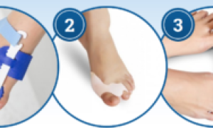 Лечение и исправление вальгусной деформации большого пальца стопы