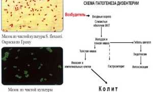 Возбудитель шигеллеза, его симптомы и лечение