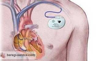 Жизнь с кардиостимулятором: какие есть ограничения