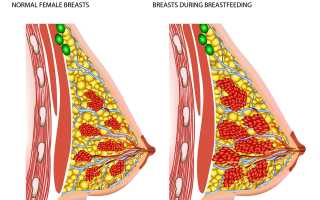 Мастит у кормящей матери: симптомы и лечение. Что делать при застое молока?