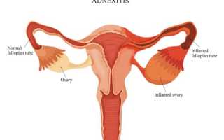 Аднексит симптомы и лечение у женщин, стоит ли бояться, какие последствия +видео консультация с гинекологом
