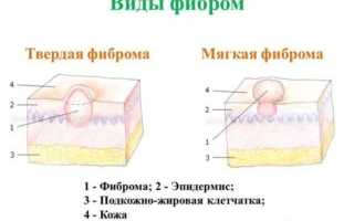 Шишка между ребрами в области солнечного сплетения у мужчин и женщин