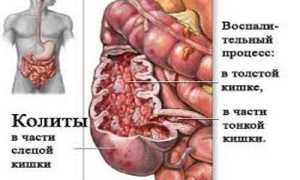 Болезни слепой кишки: симптомы, лечение и профилактика