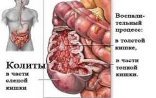 Болезни слепой кишки: симптомы, лечение и профилактика