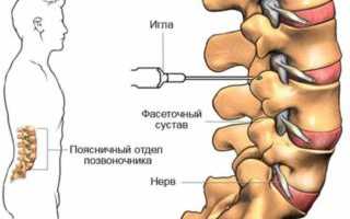 Что такое синовит дугоотросчатых суставов позвоночника