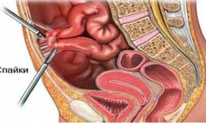 Спаечная болезнь брюшной полости: как проявляется и лечится патология?