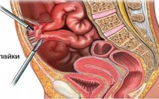 Спаечная болезнь брюшной полости: как проявляется и лечится патология?