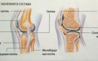 Симптомы и лечение травм внутренней (медиальной) боковой связки коленного сустава