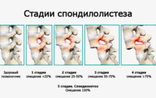 Классификация заболеваний позвоночника