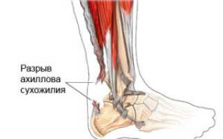 Причины болей ахиллова сухожилия по утрам и при беге у детей и их лечение