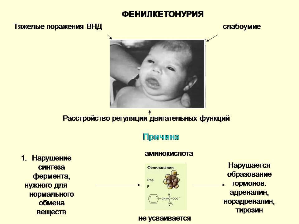 фенилкетонурия_клиника