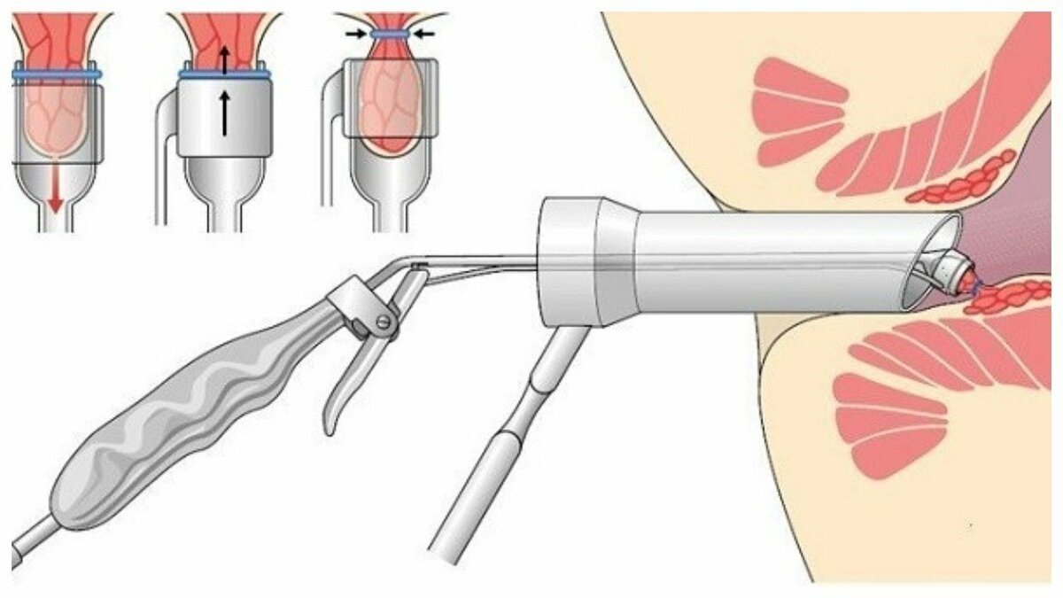 Избавление от геморроя хирургическим путем