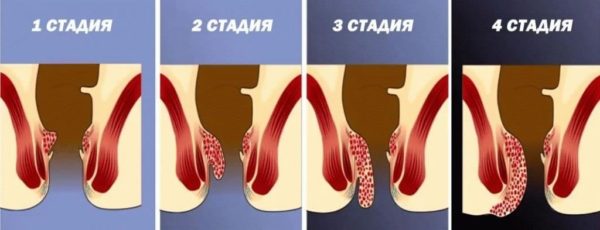 Стадии геморроя и их симптомы