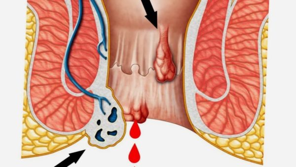 Причины кровотечения при геморрое