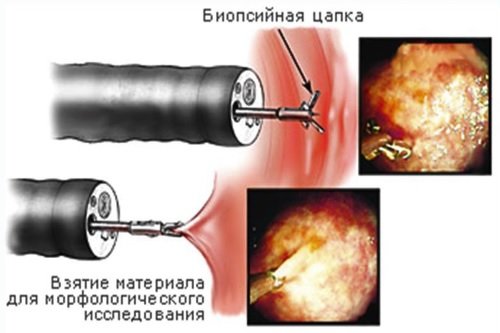 Biopsija