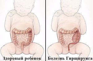 Здоровый и больной ребенок