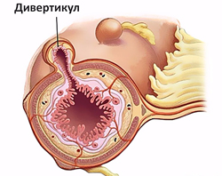 Дивертикулярная болезнь