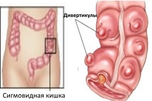 Divertikuly-na-sigmovidnoj-kishke