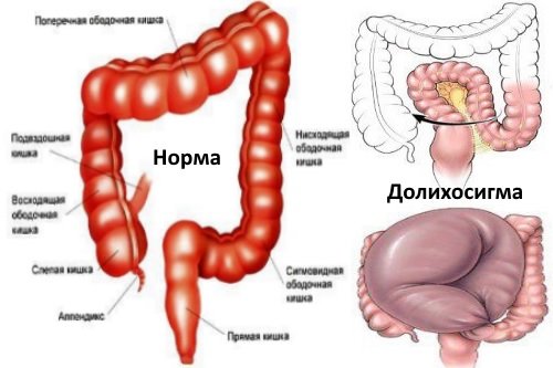 Dolihosigma-kak-patologija-kishechnika